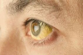 yellowing of the whites of the eyes